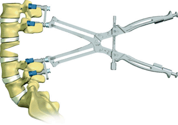 Image: The ReDux Plier for use during of pedicle subtraction osteotomies (Photo courtesy of Medtronic).